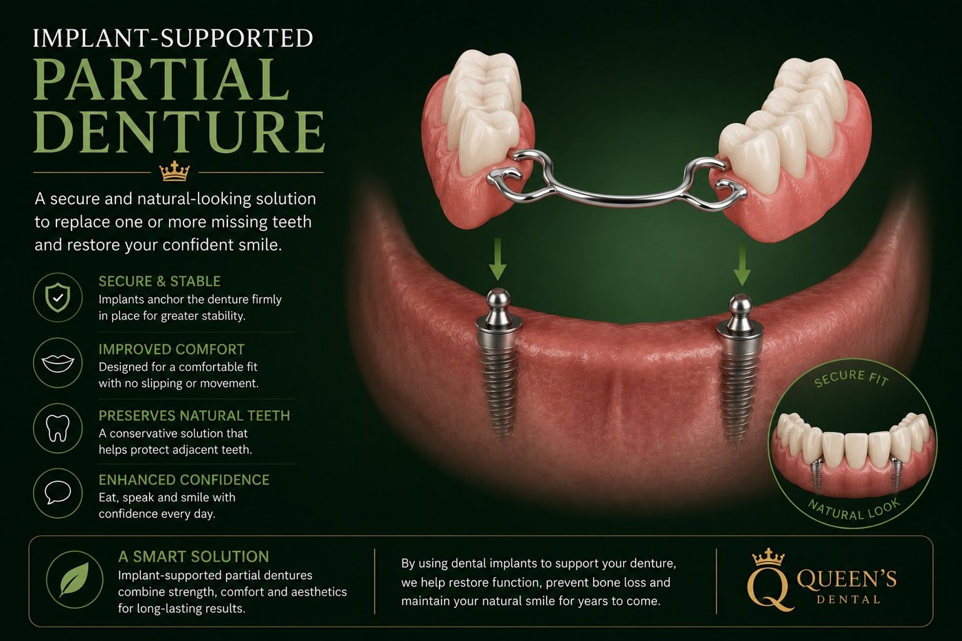 Implant-supported partial denture replacing several missing teeth